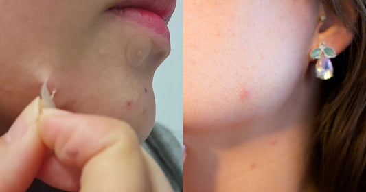 Zits outbreak? No worries, let’s absorb them all!