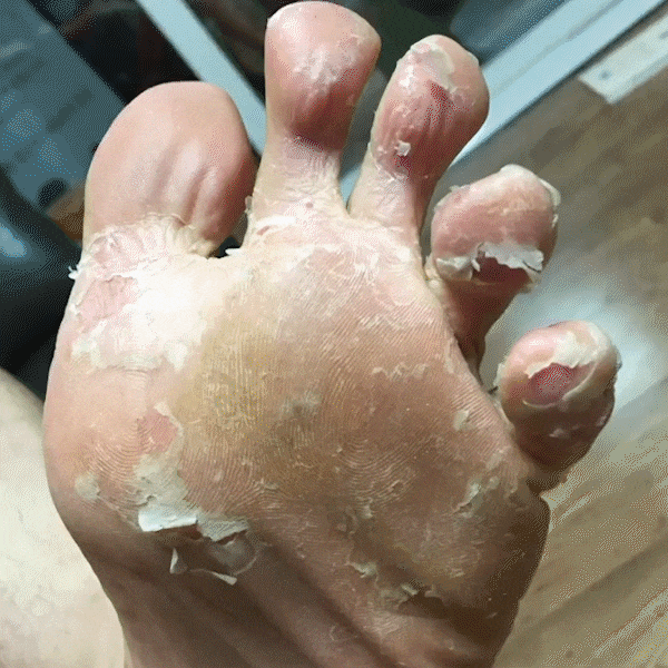 Dr. wonder foot exfoliating mask, gently removes dead skin cells and rough patches, revealing soft and smooth skin underneath.